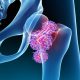 Bone Tumors Treatment درمان تومورهای استخوانی